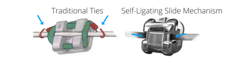 What are Self-Ligating Braces?
